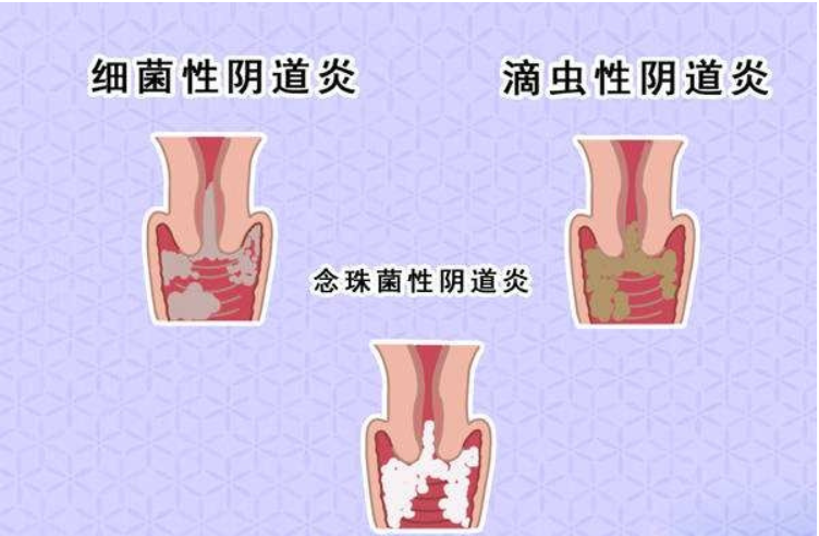调理霉菌性阴道炎，先熏再洗，一个疗程明显改善了