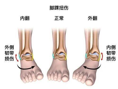 一个扭伤的方子；外用的方子，效果棒棒的