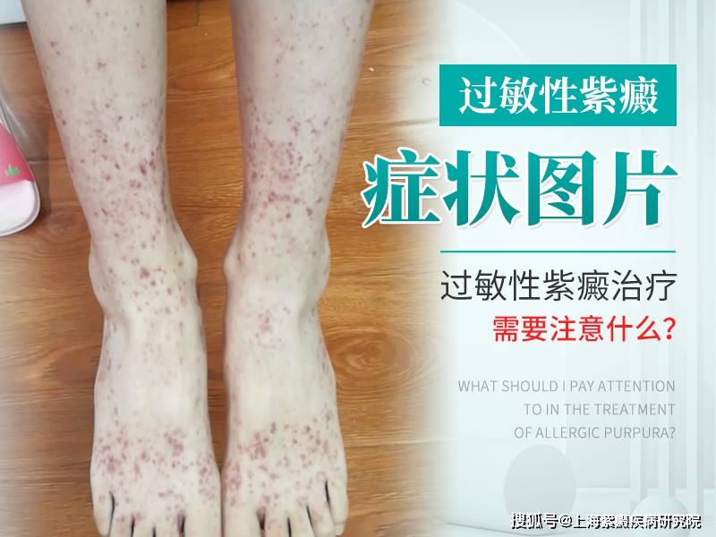 过敏性紫癜的验方大公开