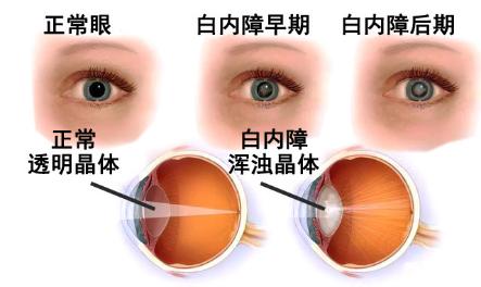 白内障。症状：双眼视物模糊不清。眼前出现黑色点状、片状阴影，视物疲劳，四肢乏力，大便溏薄。