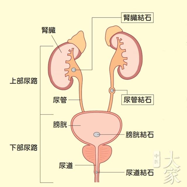 尿路结石，肾结石。