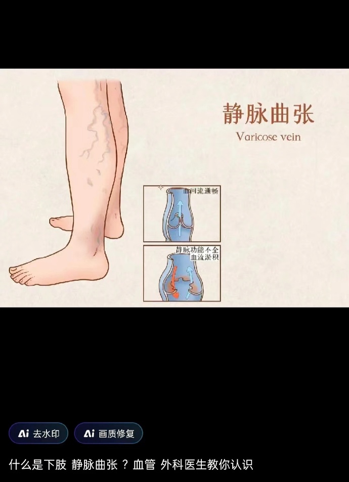 静脉曲张:静脉曲张、对两脚酸疼、腿痉挛、腿抽筋、劳累过度所导致的手臂酸麻胀痛效果很好。