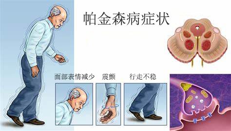帕金森综合症：症状和病因：手或头会有抖动，或者拿杯子和筷子时有抖动感。指甲变软变薄，容易腰间盘突出。男子失精过多，女子梦交。