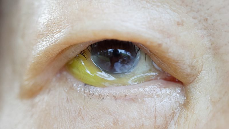 眼底黄斑病变。症状：视物不清，自觉眼前有一黑影遮盖如云雾，发灰暗色，视力下降。