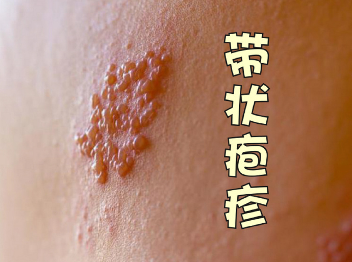 带状疱疹蛇盘疮判断为热毒犯于肝肺二经。治肝用理肝宣肺，清热解毒。