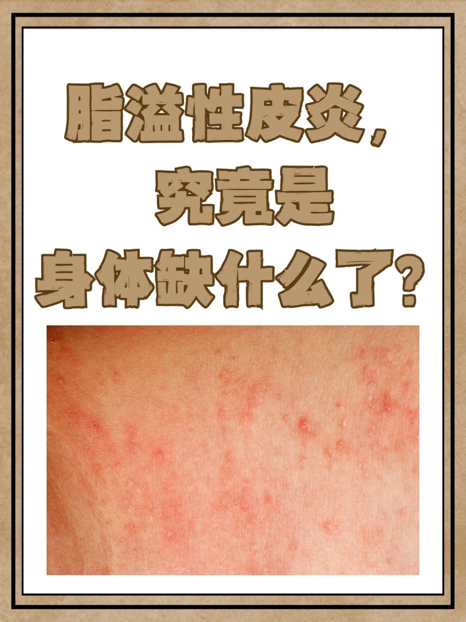 脂溢性皮炎和酒糟鼻子