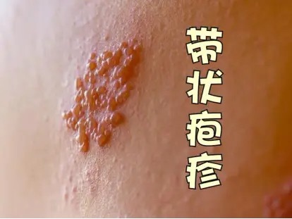 带状疱疹是由水痘带状疱疹病毒引起的急性炎症性皮肤病，中医称为缠腰火龙、缠腰火丹，俗称蜘蛛疮、生蛇。其主要特点为簇集水泡，沿一侧周围神经作群集带状分布，伴有剧烈神经痛，痛苦异常。