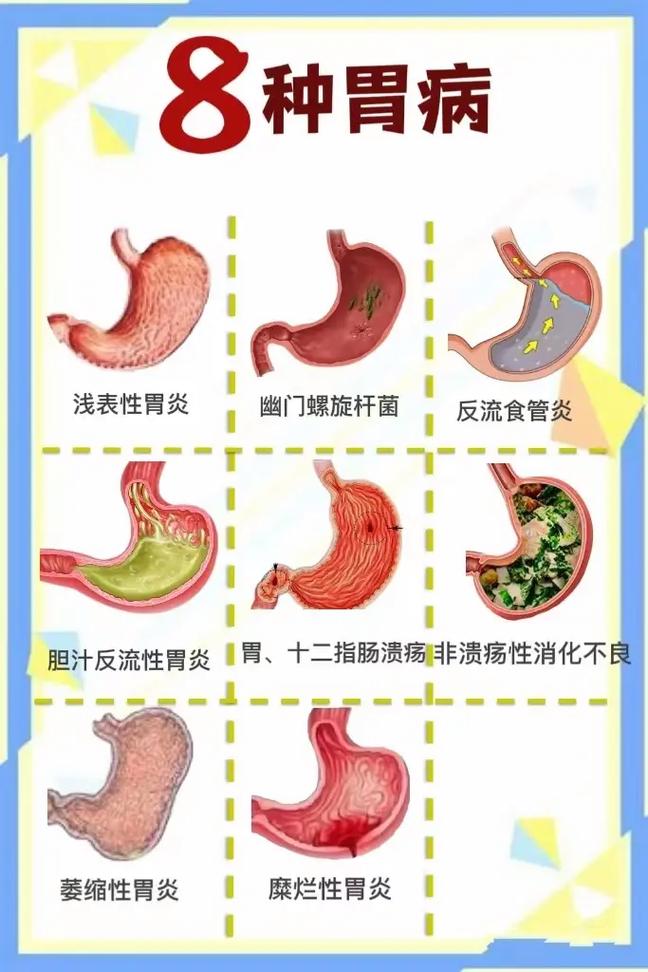胃炎速愈汤
