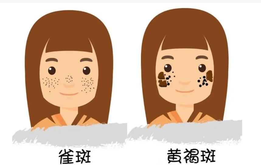 一次搞定雀斑的秘方绝招