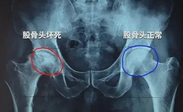 股骨头坏死特效秘方