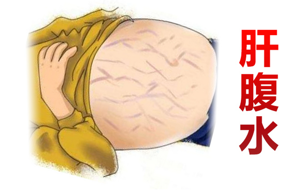 一个值得试试的救命的秘方—肝癌腹水贴