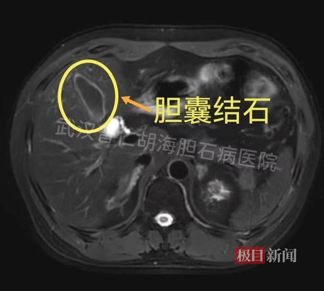 胆囊炎、胆结石秘方