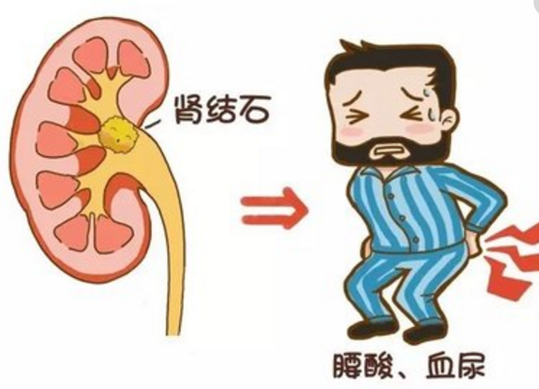 经验方—排石汤